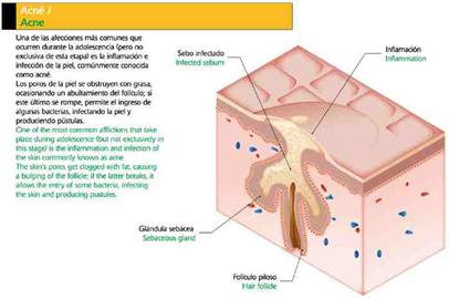 285913093il-acne[1]