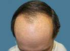 calvicie-