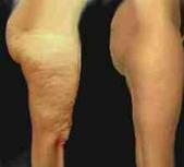celulitis[1]