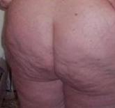 celulitis