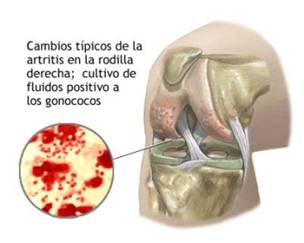 gono