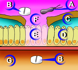 Ulcera Duodenal