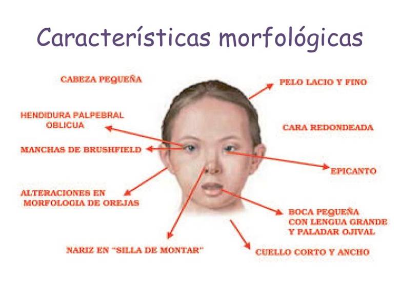 Sindrome-de-Down.jpg