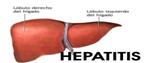 HEPATITISICO